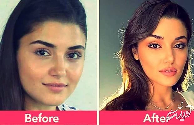 عمل زیبایی هانده ارچل